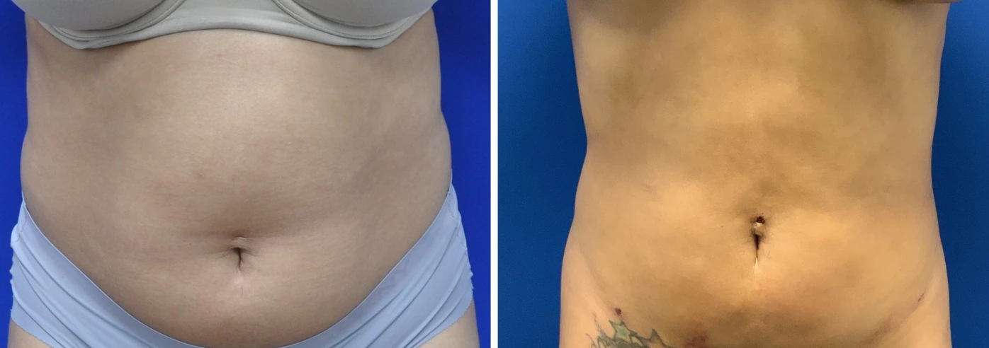 Liposuction case 13 before and after, patient torso displaying enhanced abdominal contours