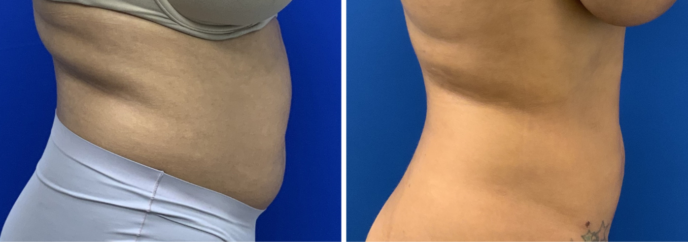 liposuction case 13-002