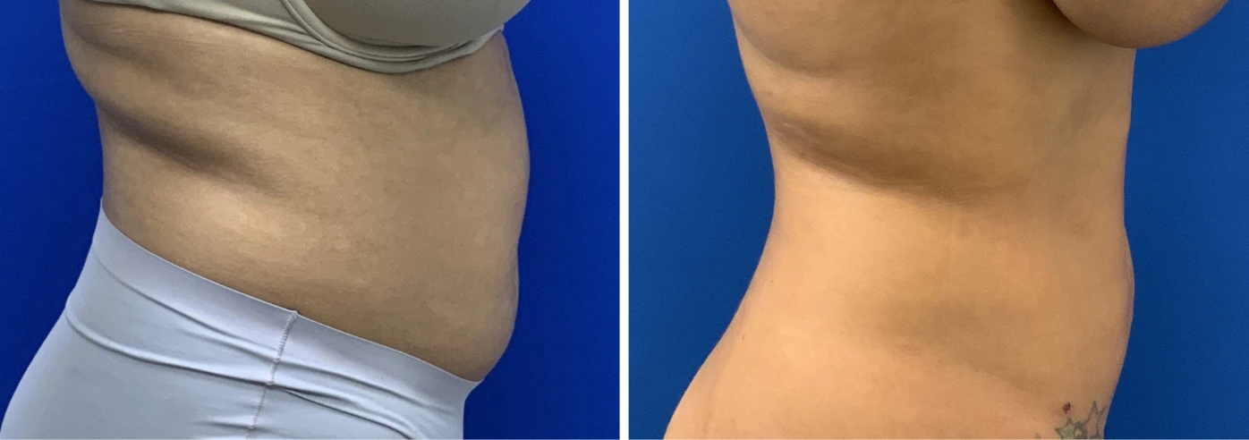 Liposuction case 13 before and after, patient torso showing improved body contour and definition