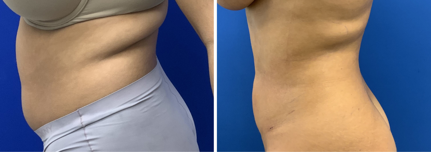 liposuction case 13-003