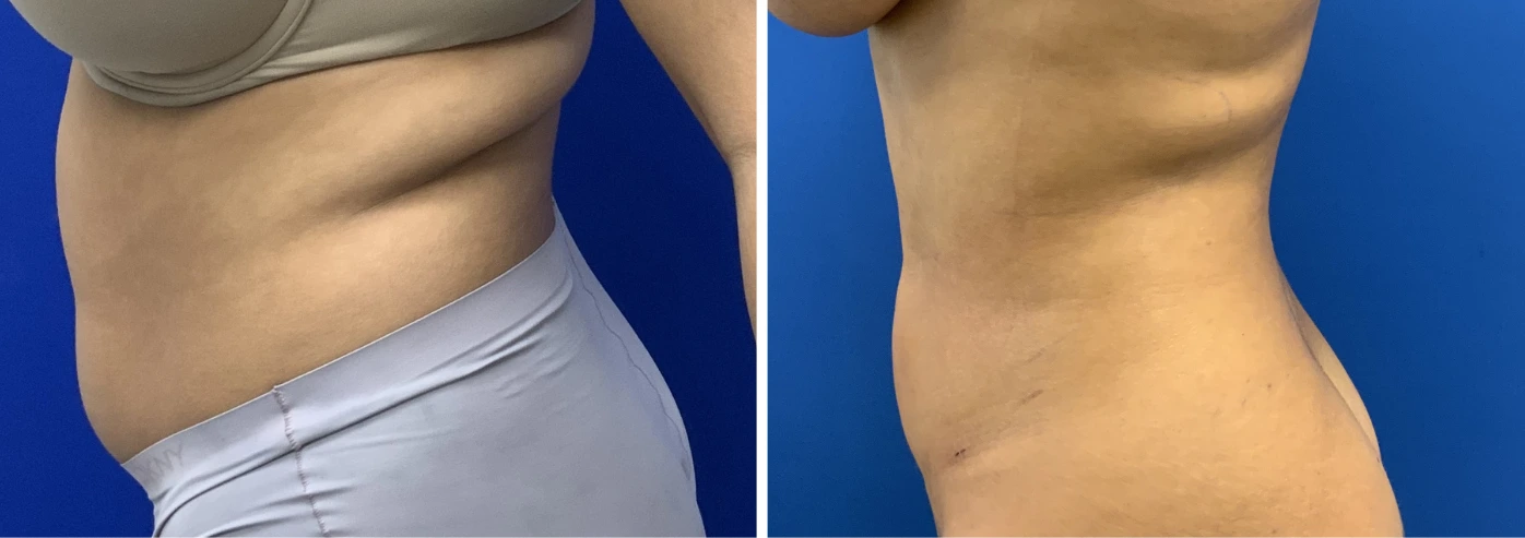 Liposuction case 13 before and after, patient side view showing refined waistline and abdominal shape