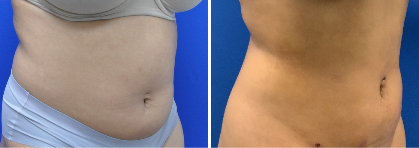 liposuction case 13-004