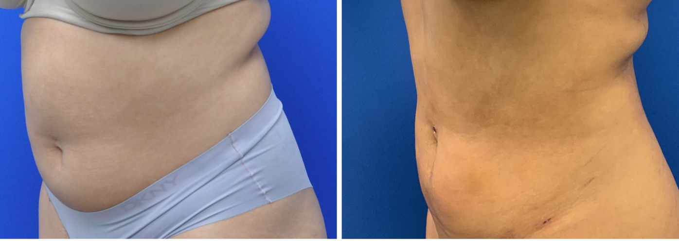 liposuction case 13-005
