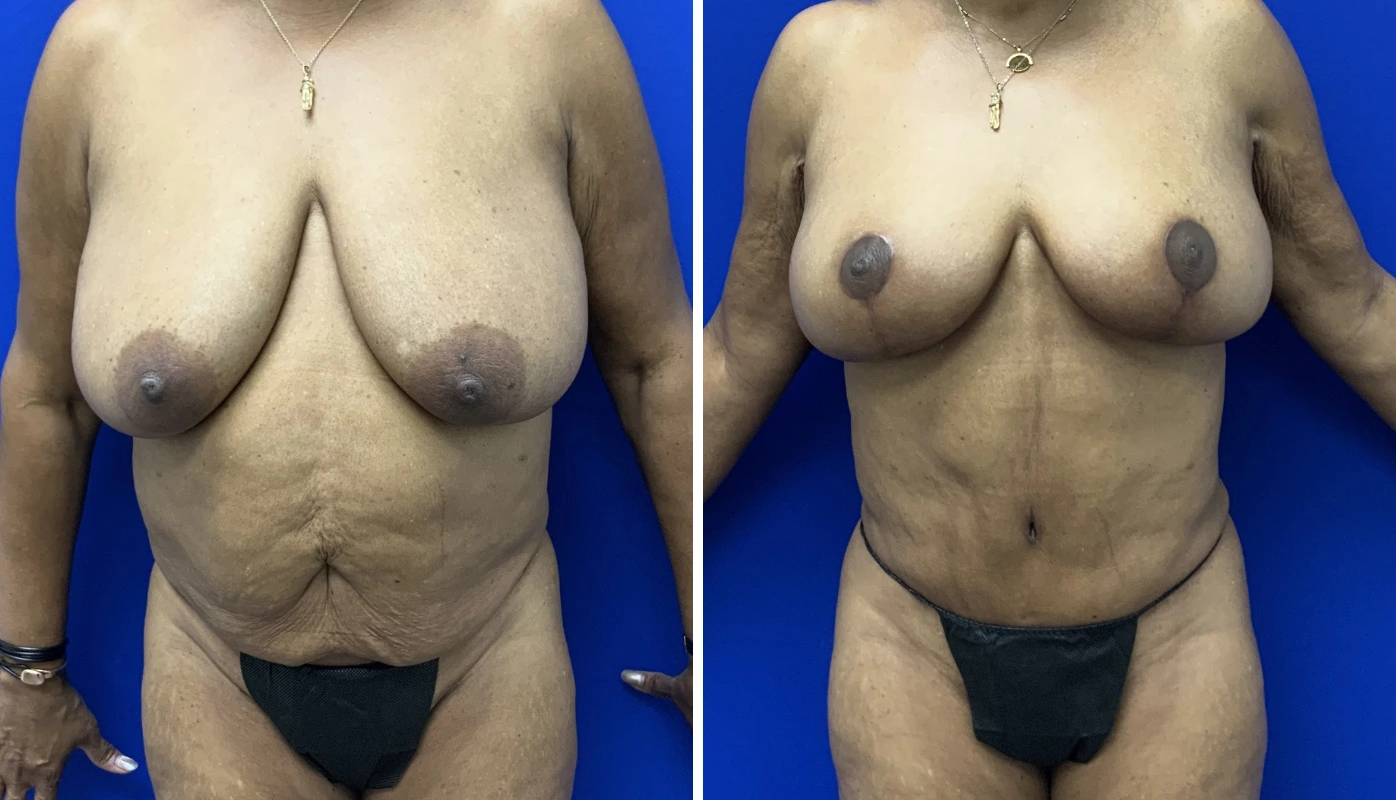 Mommy makeover case 7 before and after, front view showing complete breast and body contouring results