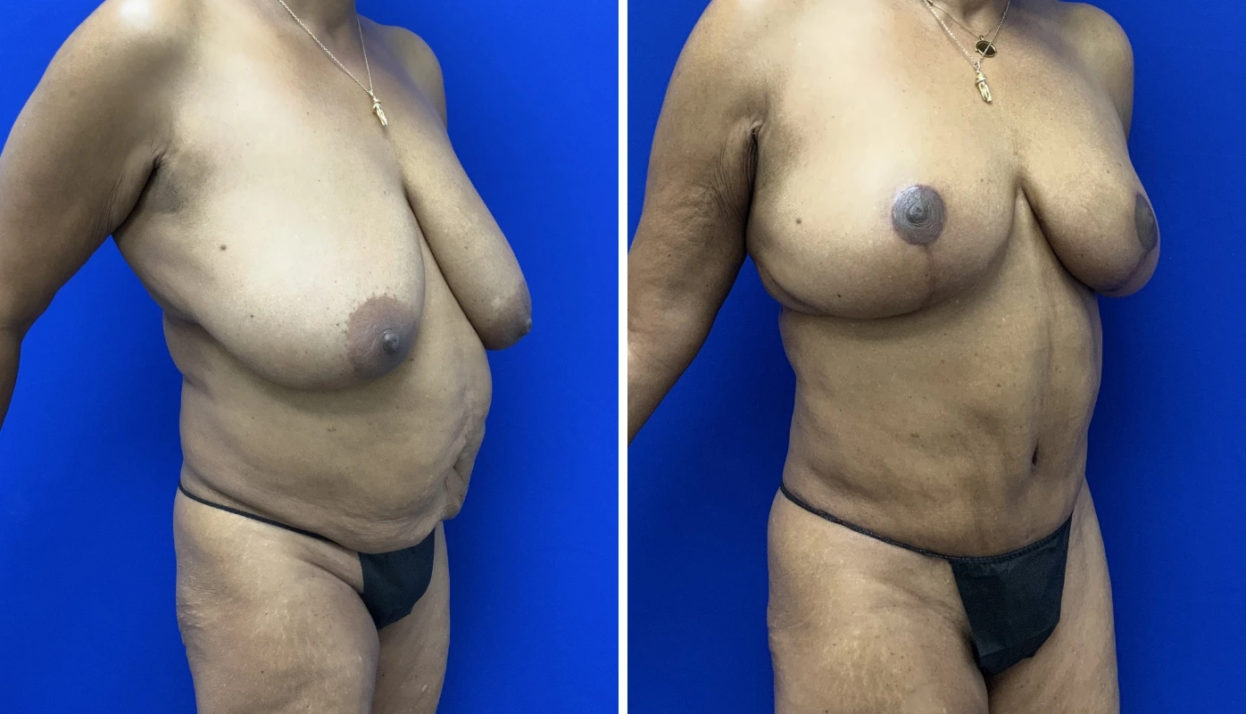 Before and after mommy makeover case 7, front view showing breast and abdominal changes