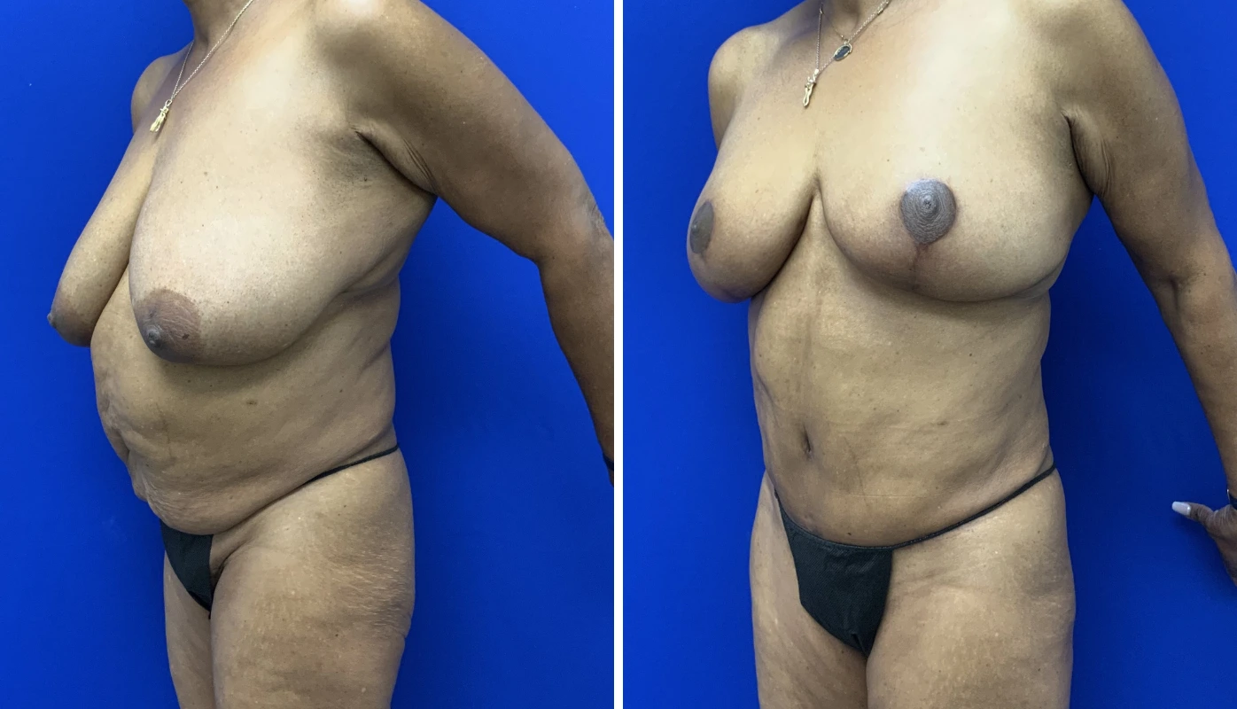 Before and after mommy makeover case 7, side view showing breast and torso contouring