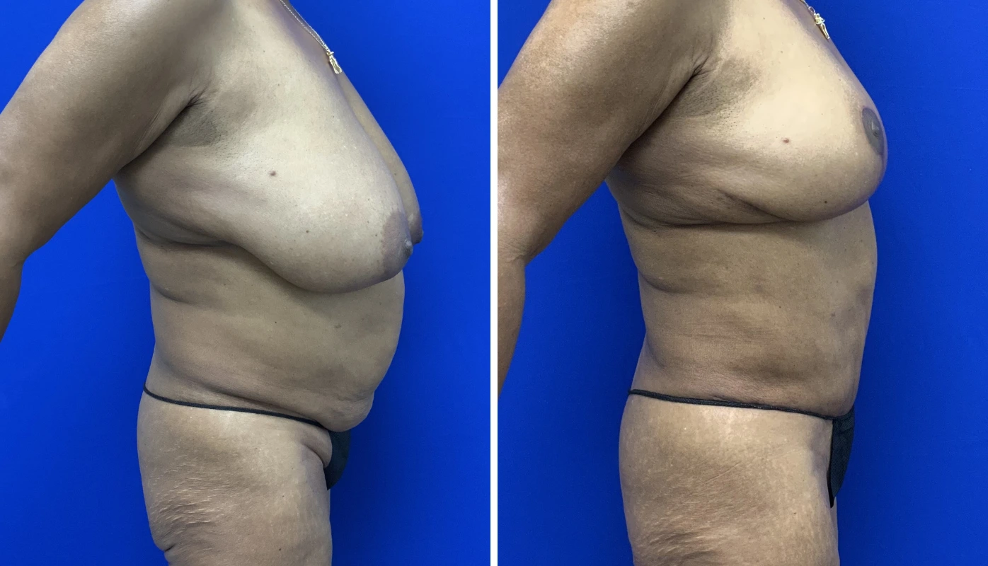 Before and after mommy makeover case 7, side profile view of breast and midsection results