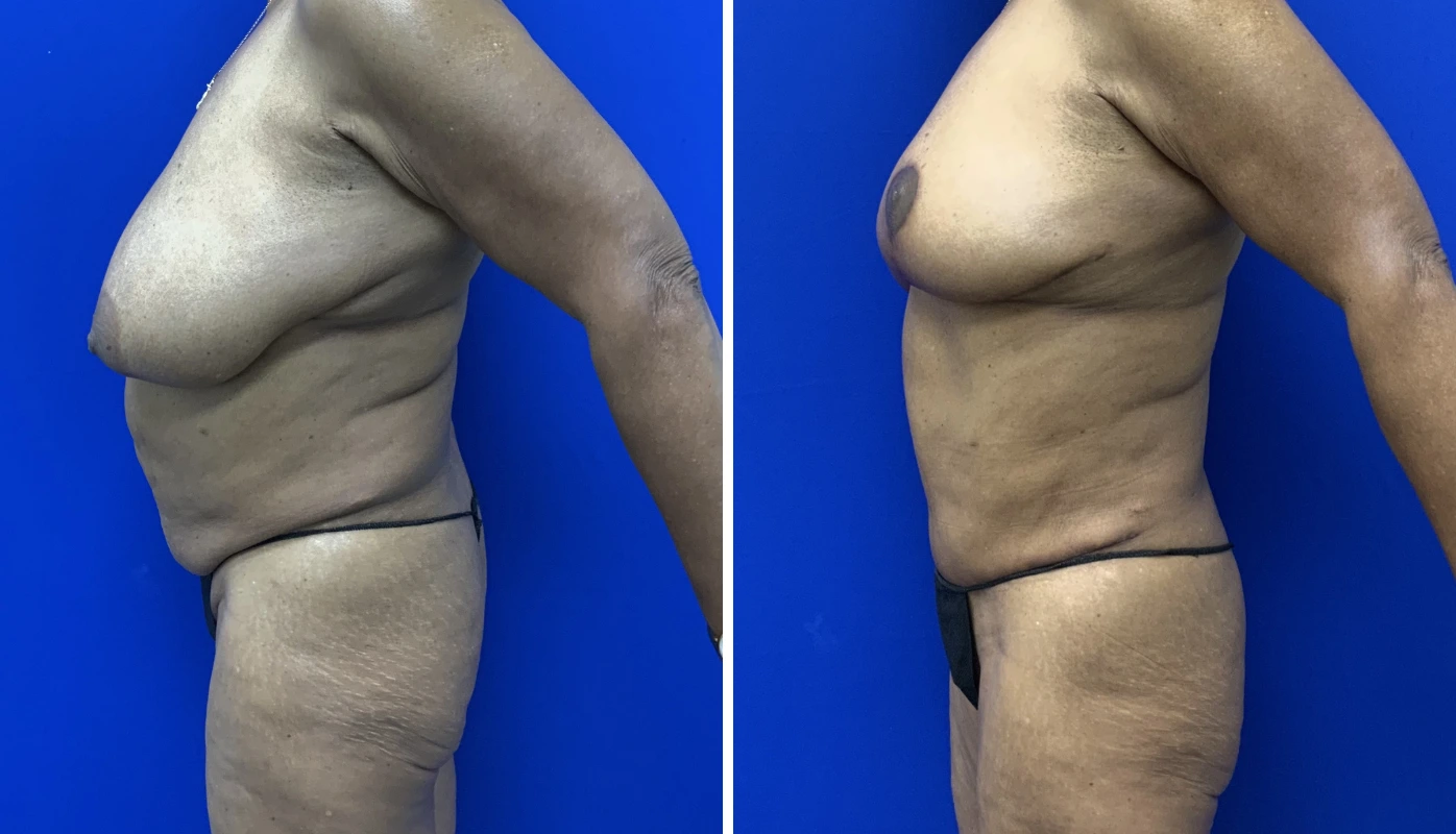 Before and after mommy makeover case 7, side angle showing breast lift and body contouring
