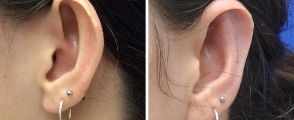Before and after otoplasty, ear repositioned closer to head from protruding angle