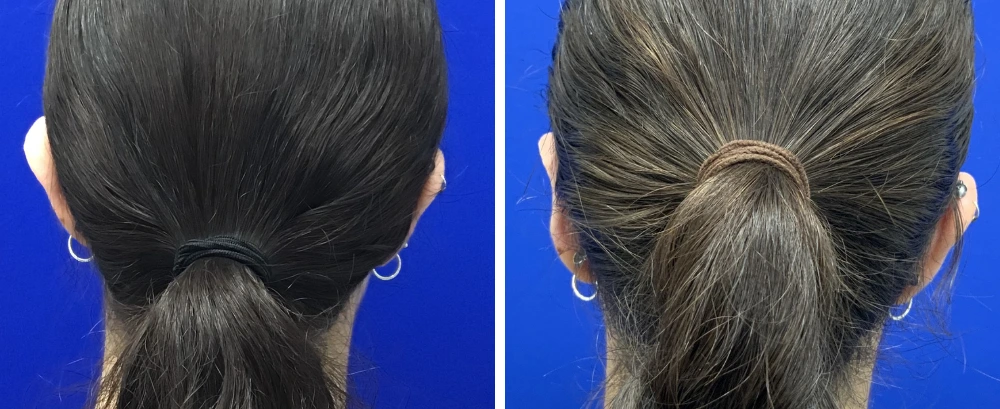 Back view before and after otoplasty, showing ears pinned back symmetrically