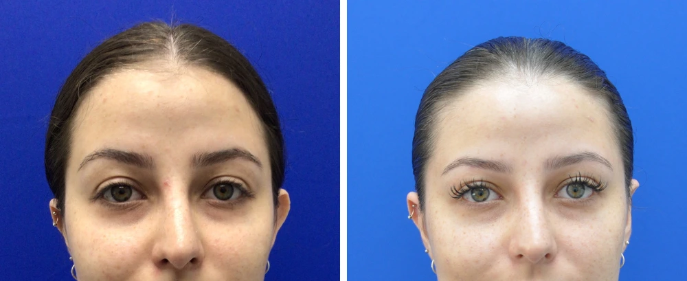 Before and after facial appearance, showing improved eye area brightness and lift