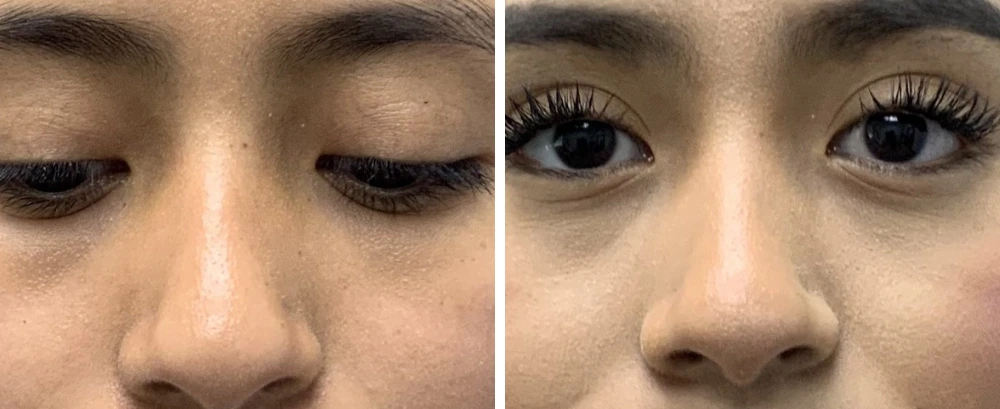 Front and oblique facial views before and after otoplasty, eyes closed and open