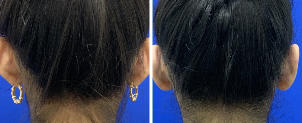 Back of head before and after otoplasty, showing ear position from rear view