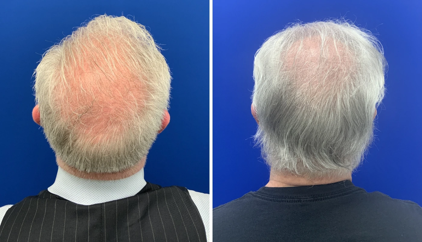 Before and after hair restoration treatment, rear view showing increased scalp coverage
