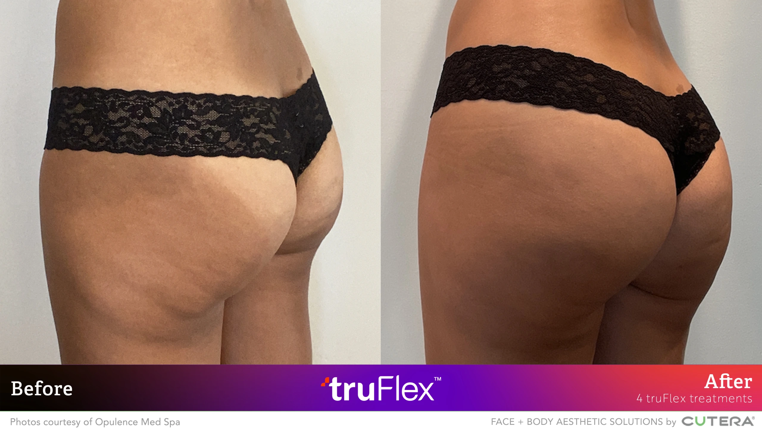 Before and after comparison of buttocks showing results after 4 truFlex treatments