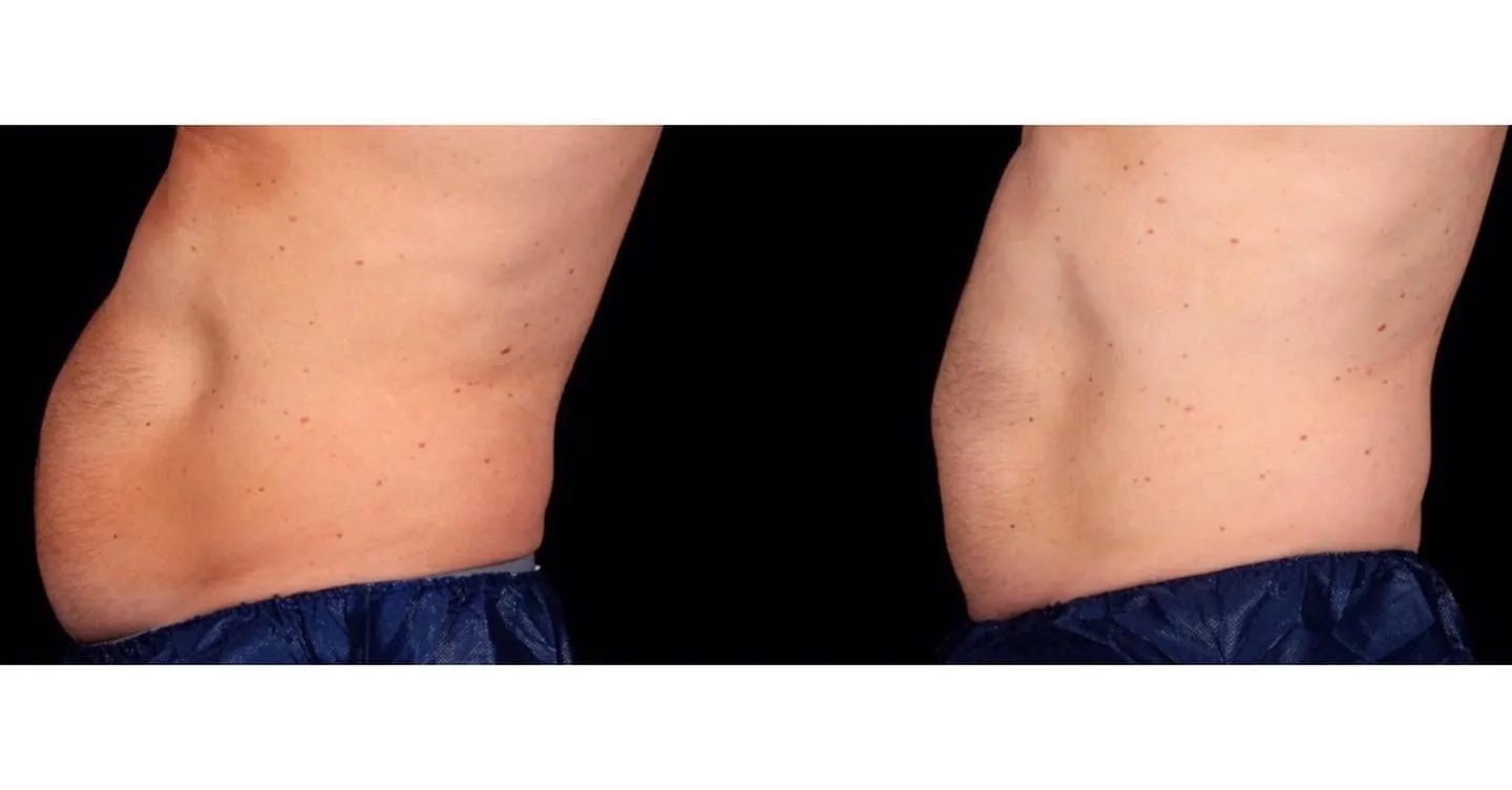 Before and after abdominal profile with truSculpt iD treatment showing reduced fullness