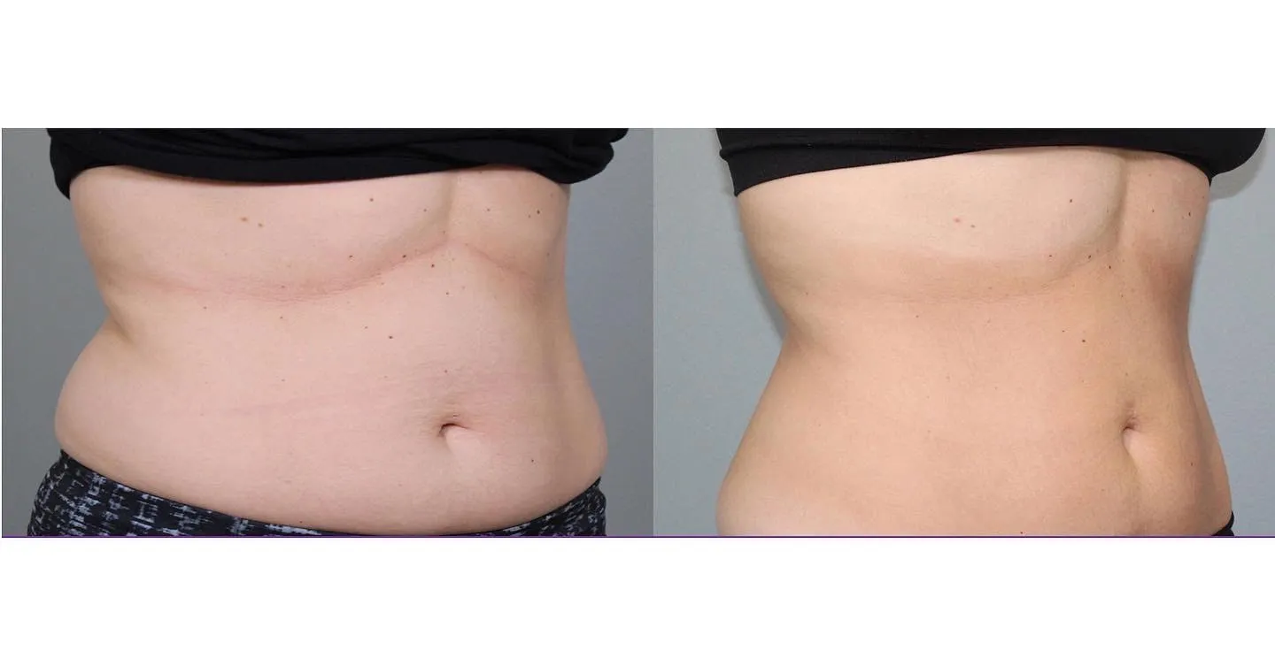 Before and after abdominal contouring with truSculpt iD treatment showing flattened midsection