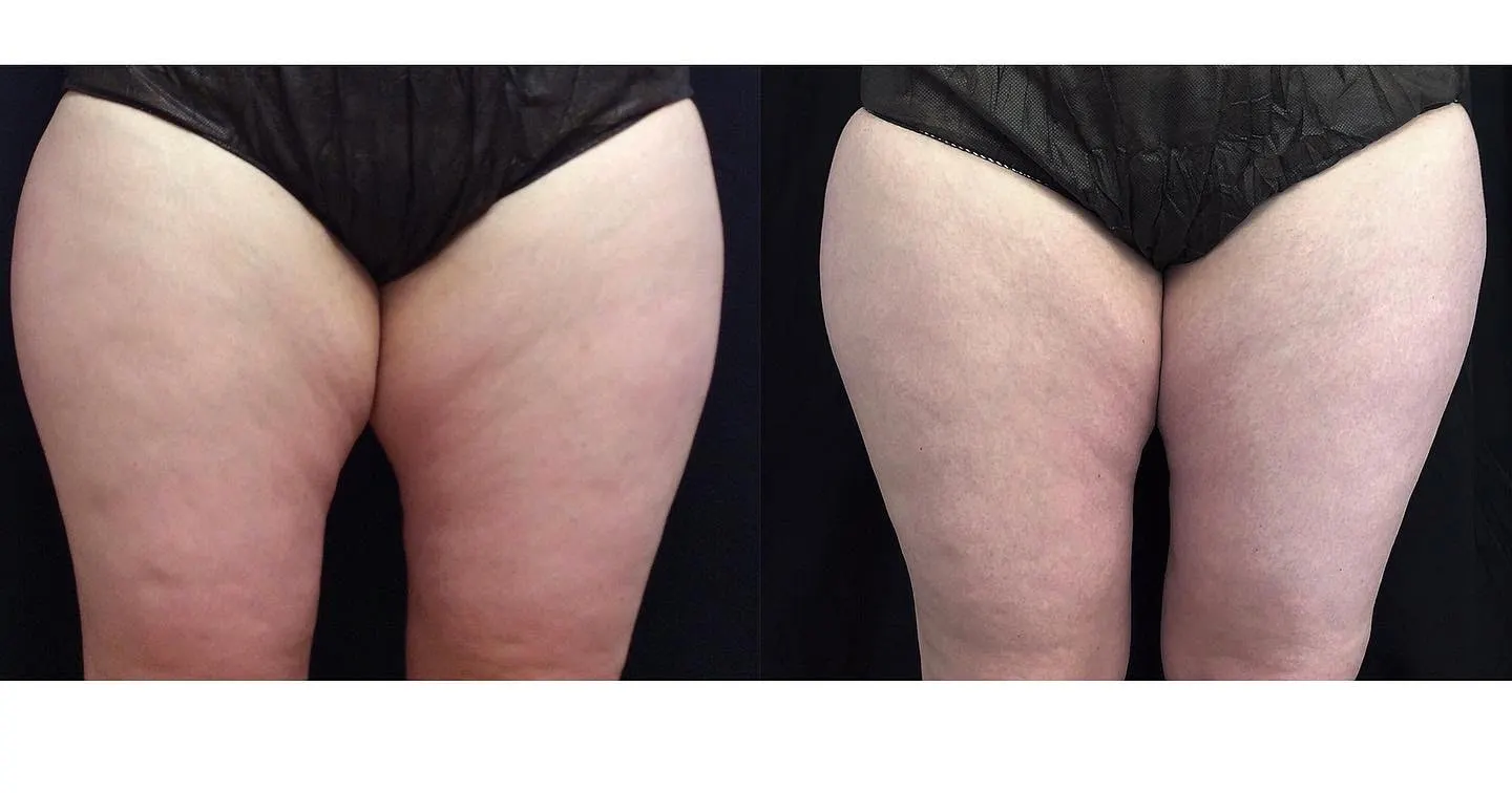 Before and after thigh appearance following Trusculpt iD treatment
