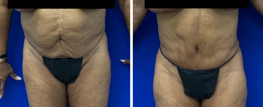 Before and after tummy tuck surgery, patient shown from front view against blue background