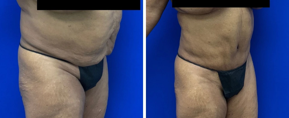 Before and after tummy tuck surgery, patient shown from oblique view against blue background