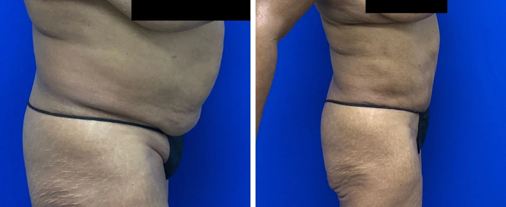 Before and after tummy tuck surgery, patient shown from side view against blue background