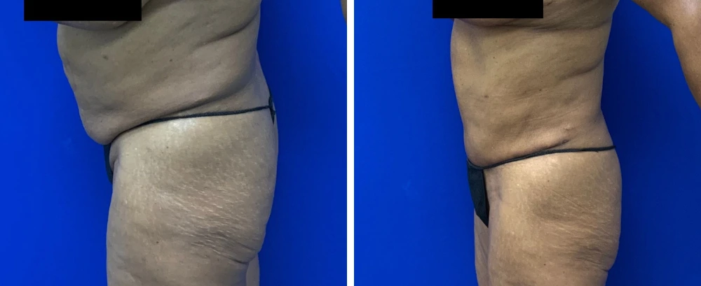 Before and after tummy tuck surgery, patient shown from side view of torso and thigh against blue background
