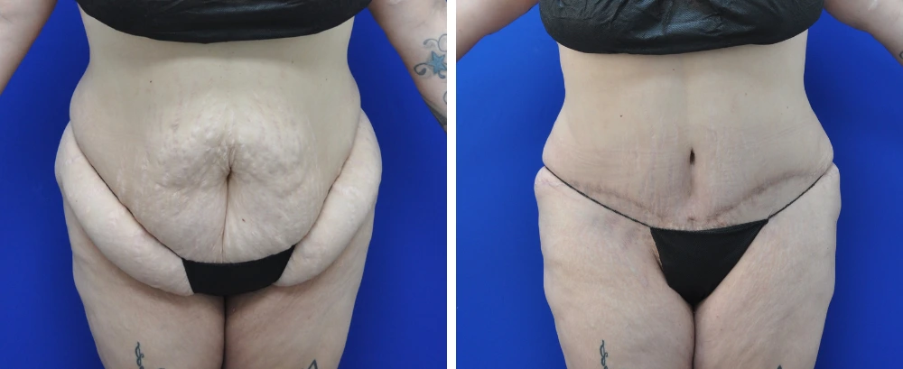 Before and after tummy tuck surgery, patient shown from back view against blue background