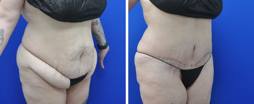 Before and after tummy tuck case 22, rear view showing abdominal contour improvement