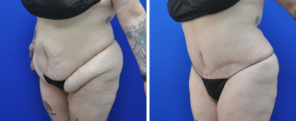Before and after tummy tuck case 22, side view showing reduced abdominal fullness