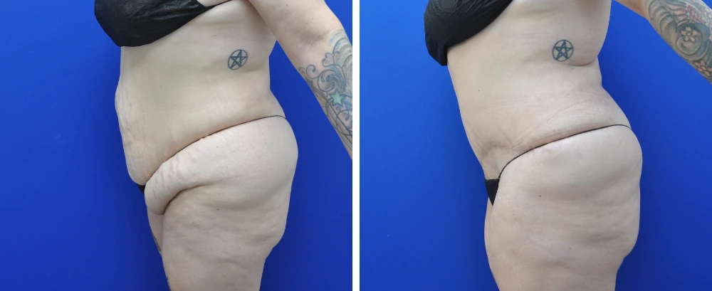 Before and after tummy tuck case 22, frontal view showing flattened abdomen