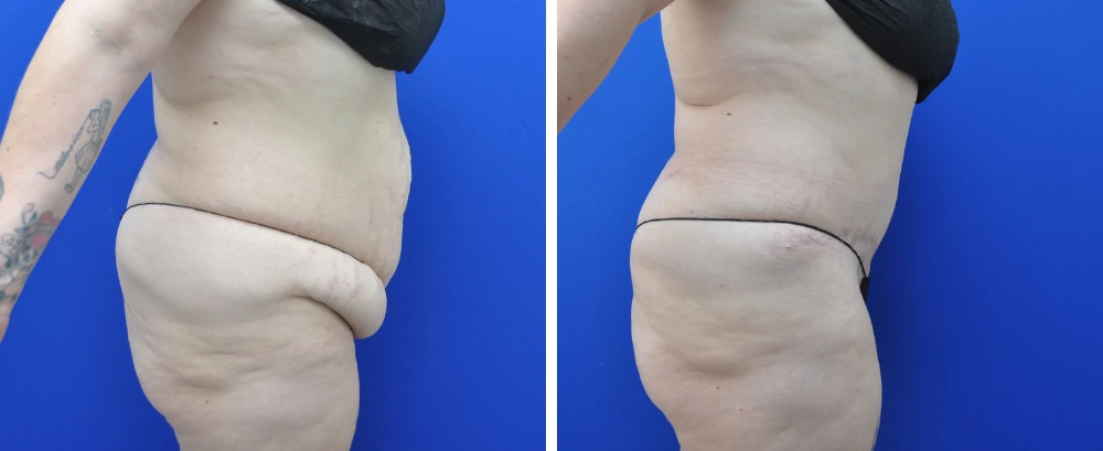 Before and after tummy tuck case 22, side profile view showing abdominal rejuvenation