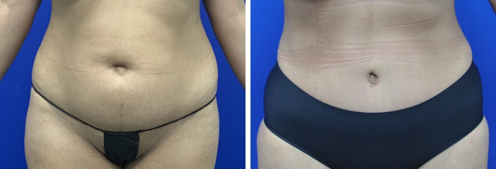 Before and after tummy tuck case 24 cropped view, front angle showing abdominal contouring results