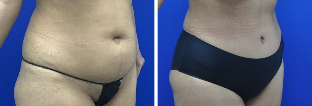 Before and after tummy tuck case 24 cropped view, front angle with reduced abdominal fullness and skin tightening
