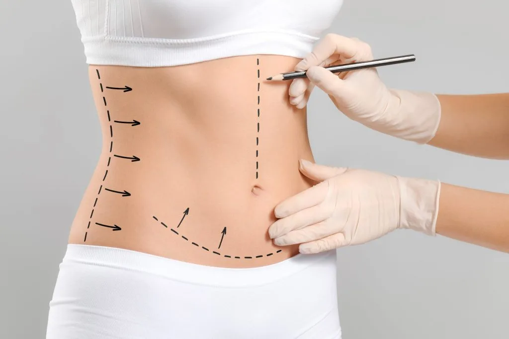 Surgeon marking abdomen with dashed lines and arrows before body contouring procedure