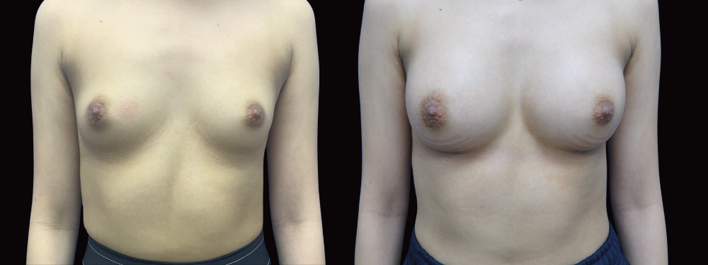 Before and after breast augmentation procedure shown from front view