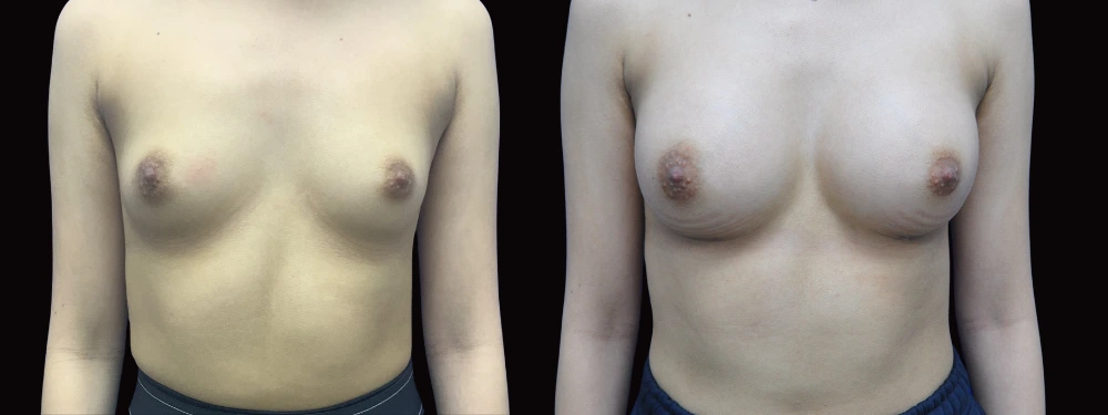 Before and after breast augmentation procedure shown from front view