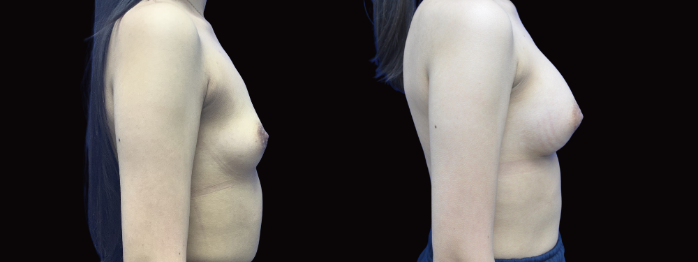 Before and after breast augmentation, right lateral view