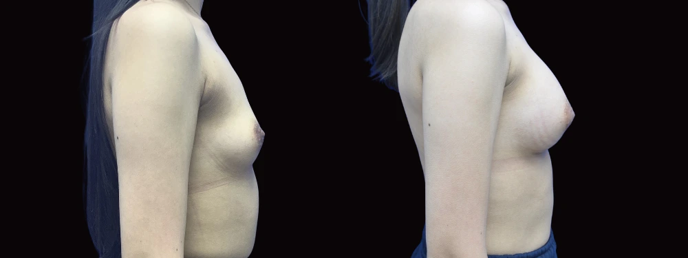 Before and after breast augmentation, right lateral view