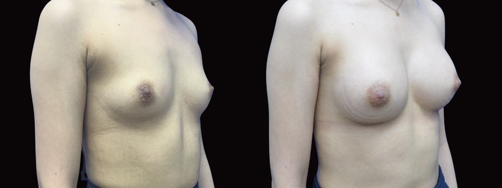Before and after breast augmentation, right oblique view