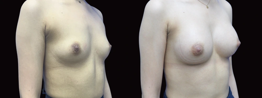 Before and after breast augmentation, right oblique view