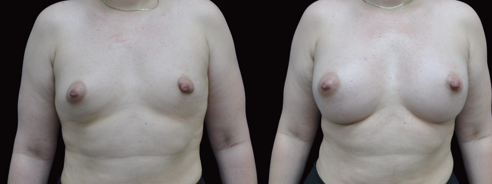 Before and after breast augmentation, anterior view