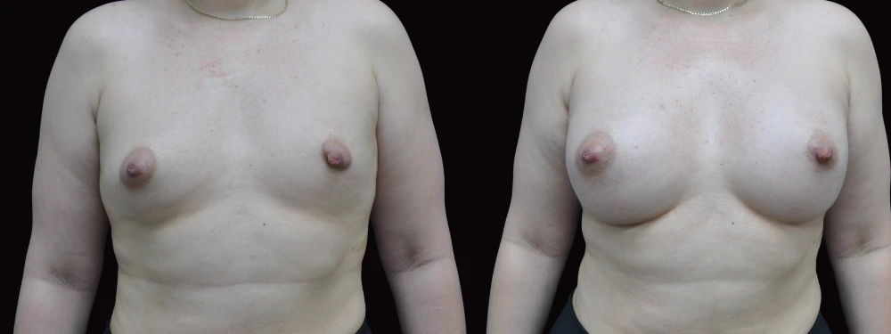 Before and after breast augmentation, anterior view
