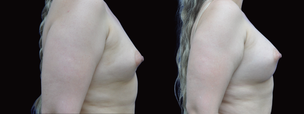 Before and after breast augmentation, right lateral view