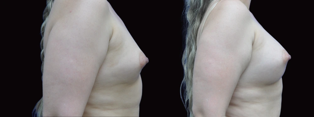 Before and after breast augmentation, right lateral view