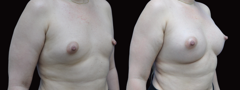 Before and after breast augmentation, right oblique view