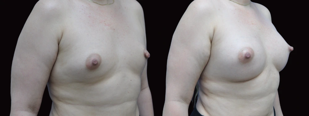 Before and after breast augmentation, right oblique view