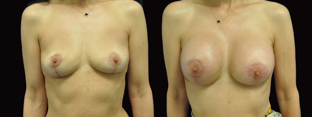 Before and after breast augmentation, anterior view
