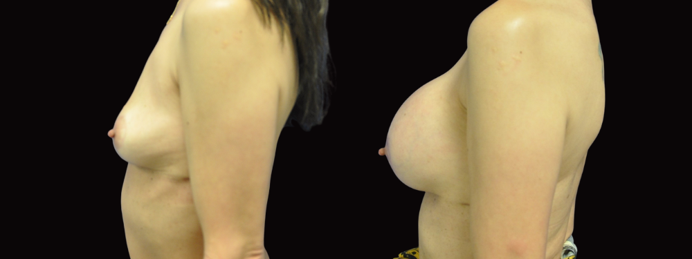 Case 13 before and after left lateral view showing breast augmentation results
