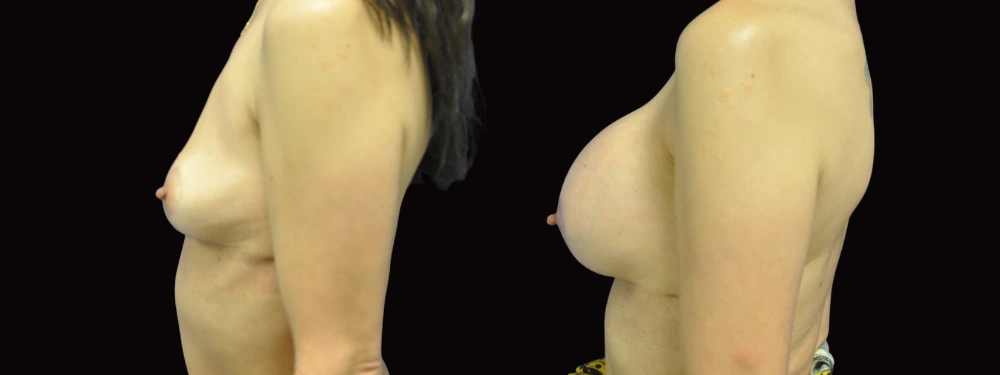 Case 13 before and after left lateral view showing breast augmentation results