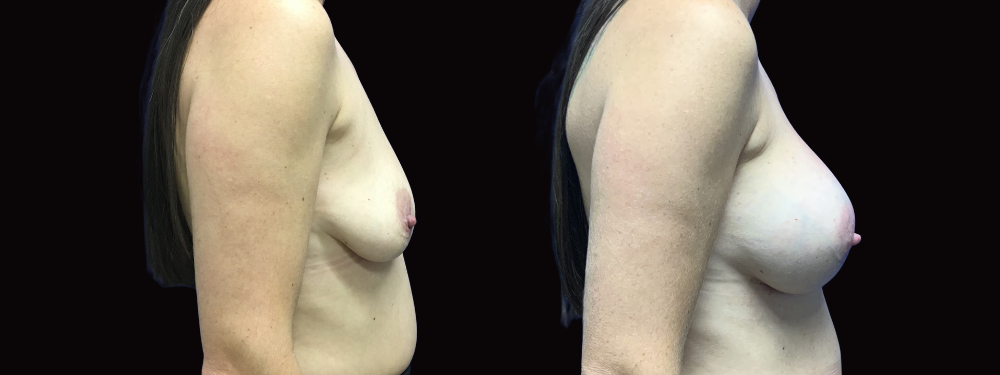 Case 14 before and after right lateral view showing breast augmentation results